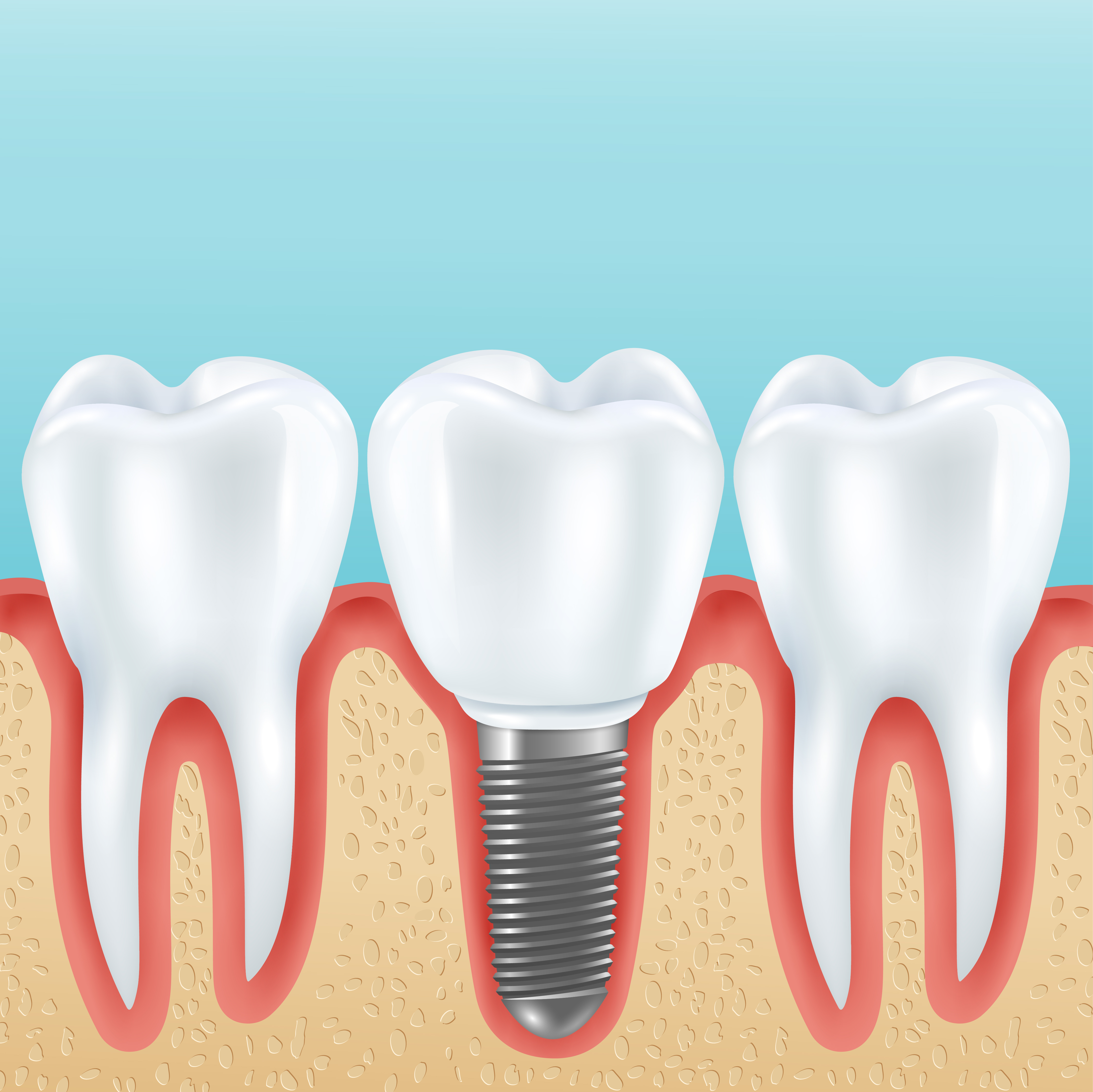 Dental implant illustration between natural teeth