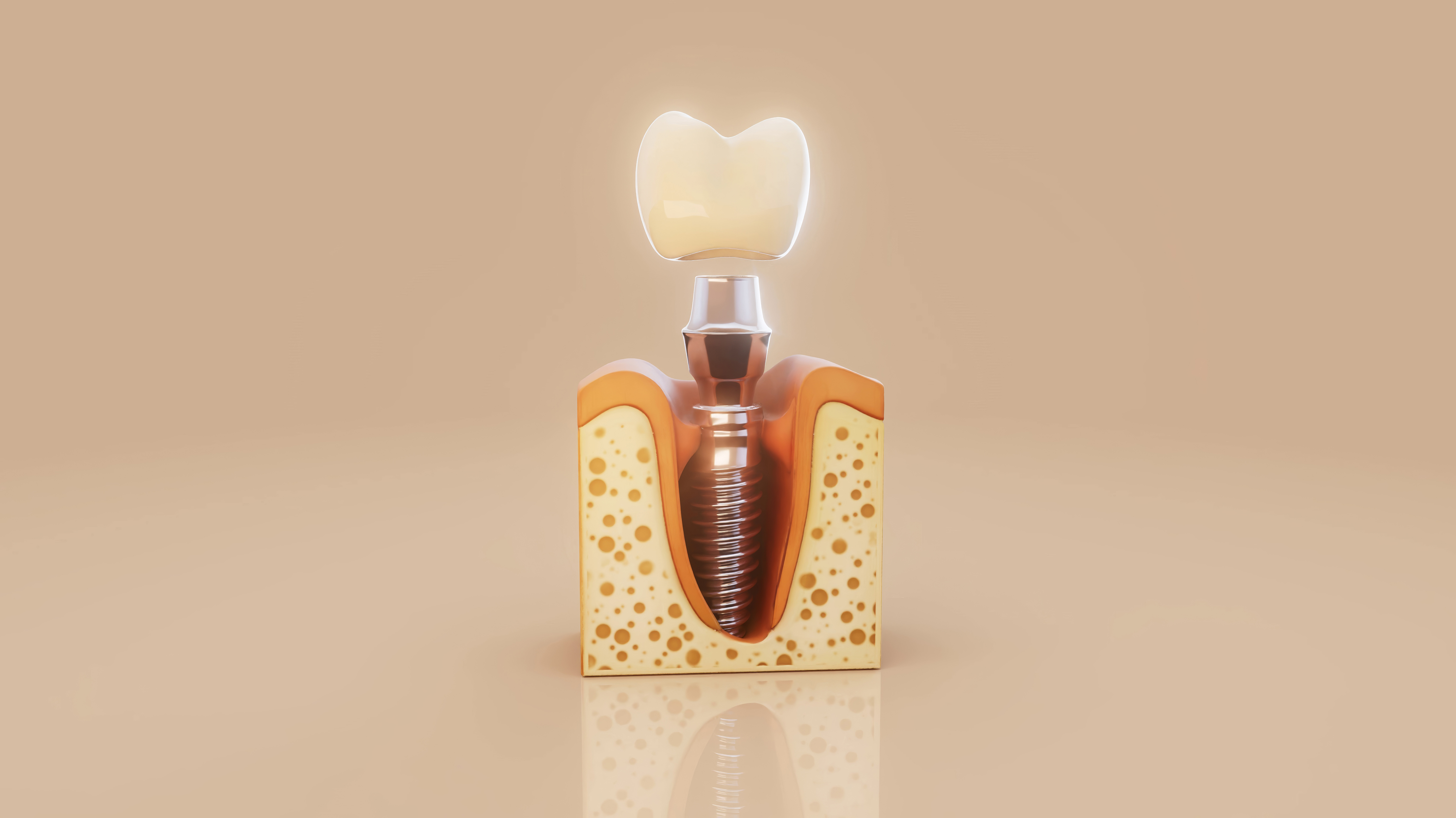 Dental implant positioned in the jawbone
