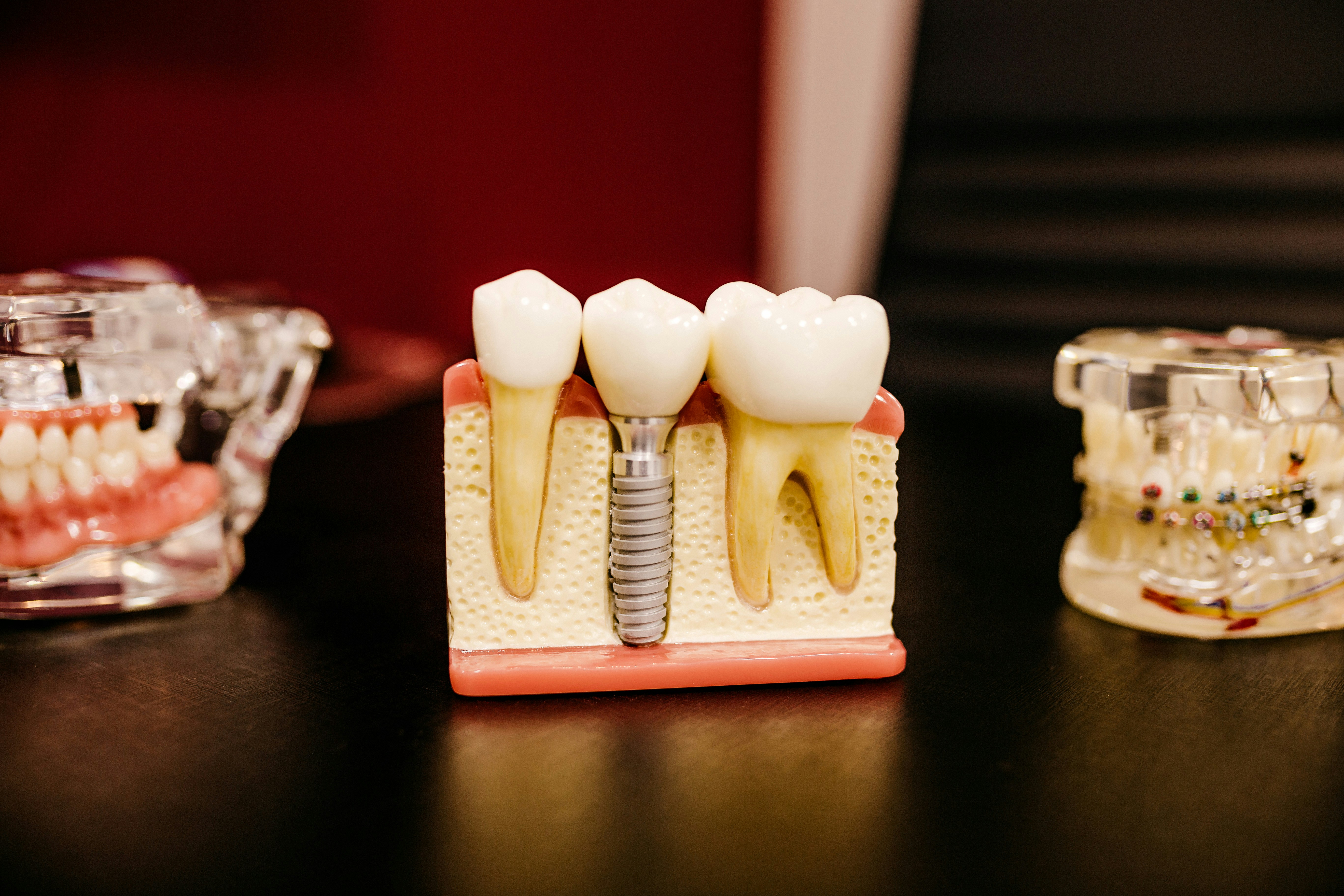Implant denture treatment planning and support illustration