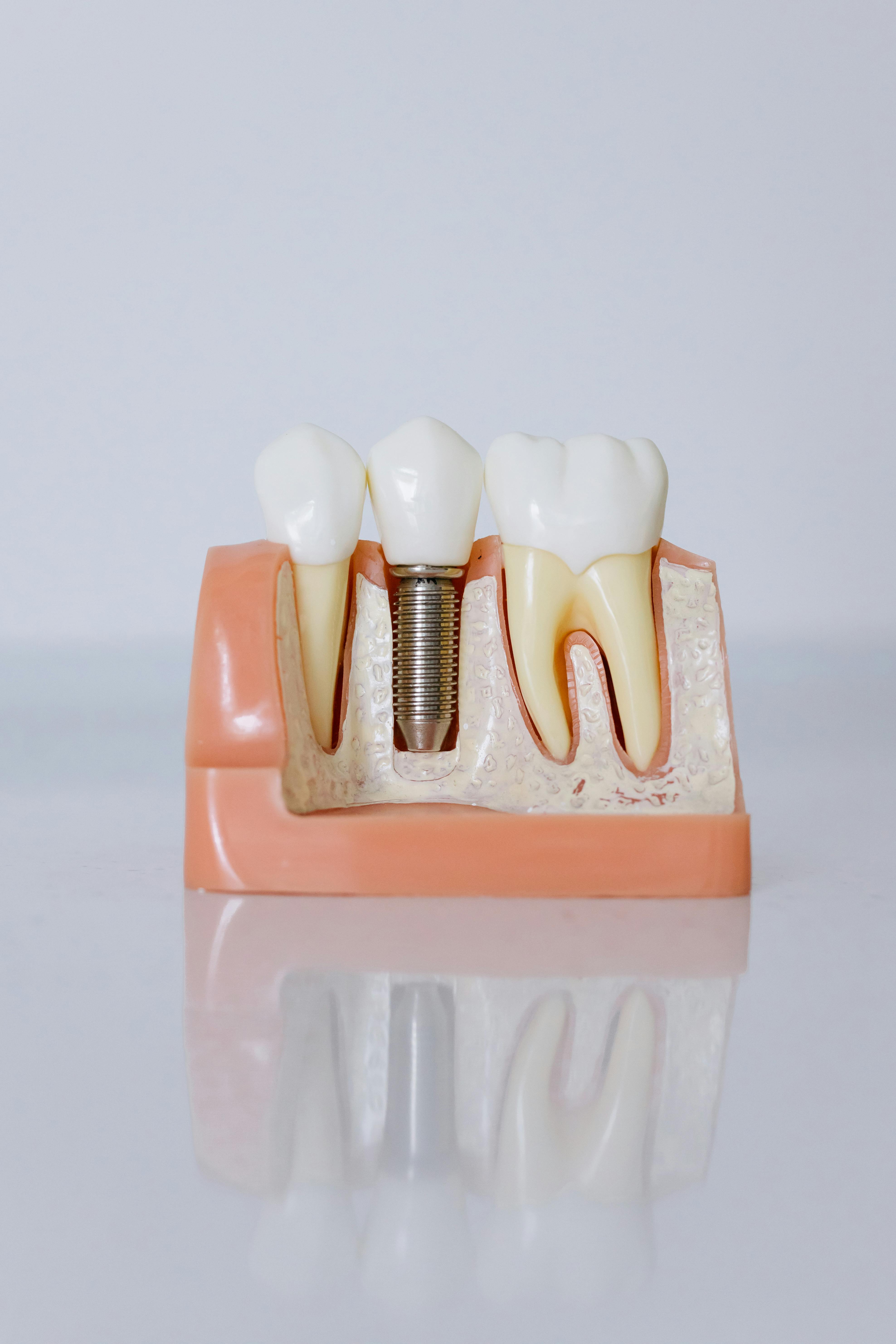 Implant dentures treatment illustration