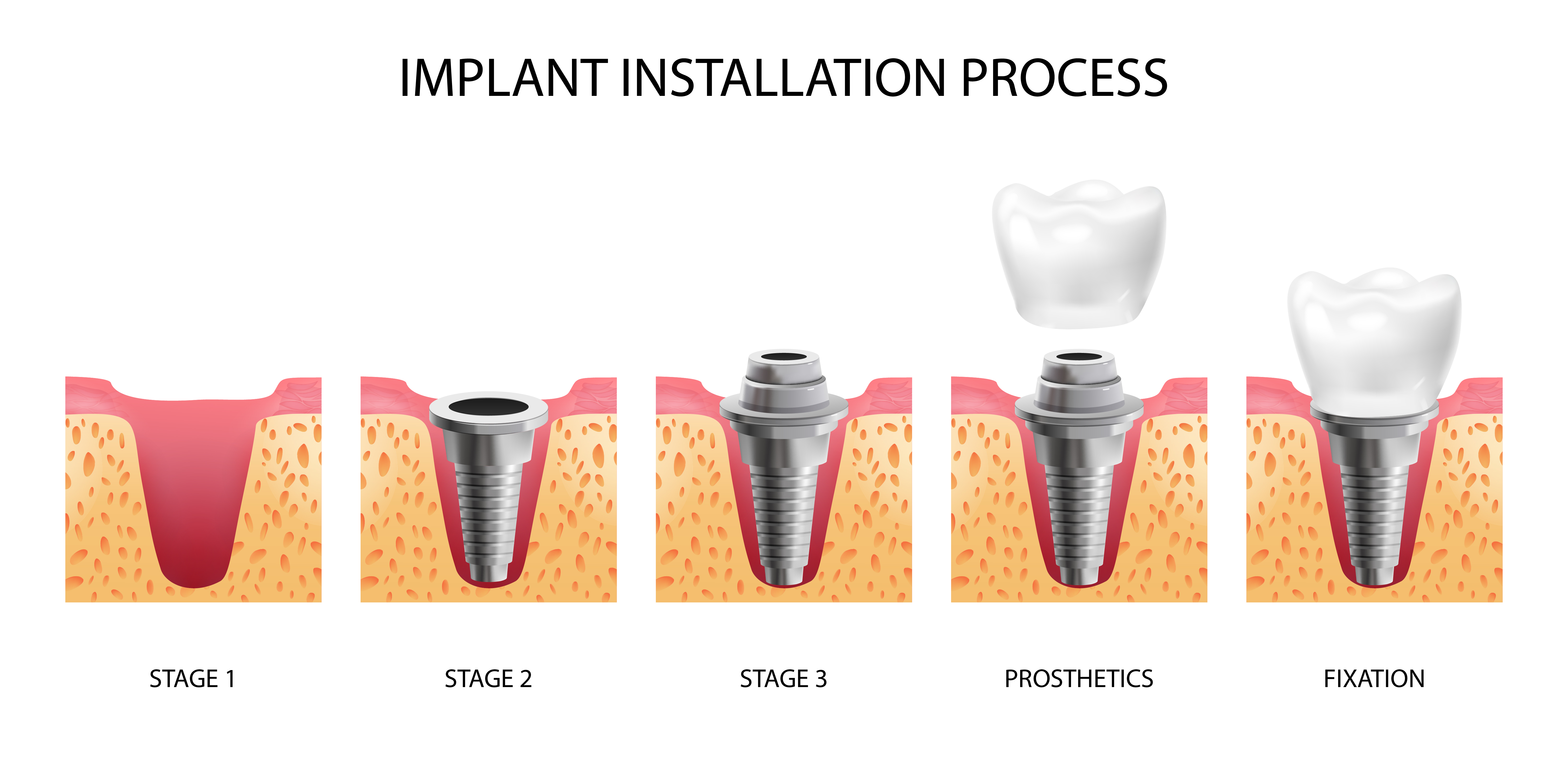 Dental implant procedure and recovery planning