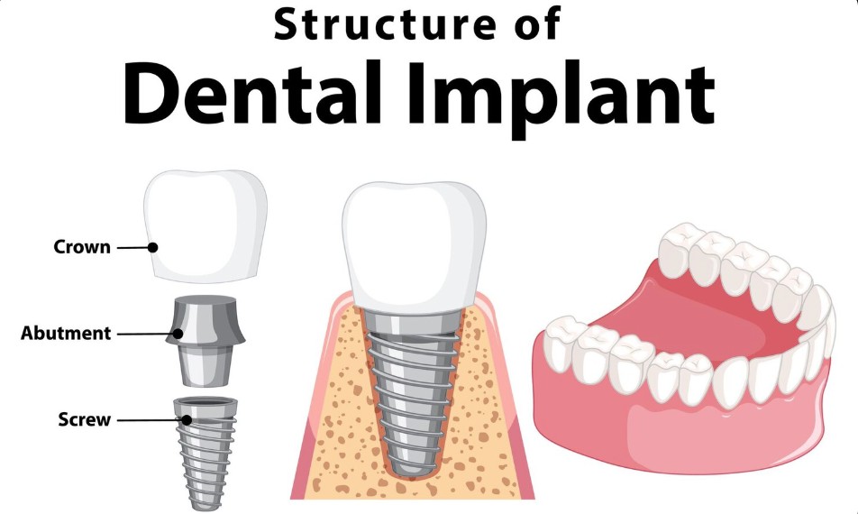Dental implant structure and placement diagram