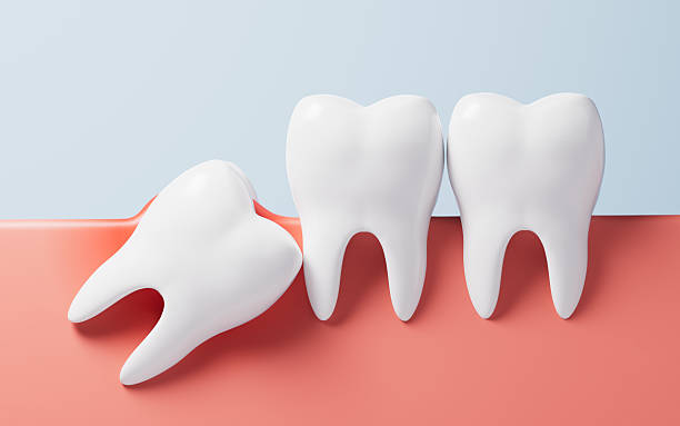 Illustration of an angled wisdom tooth beside molars